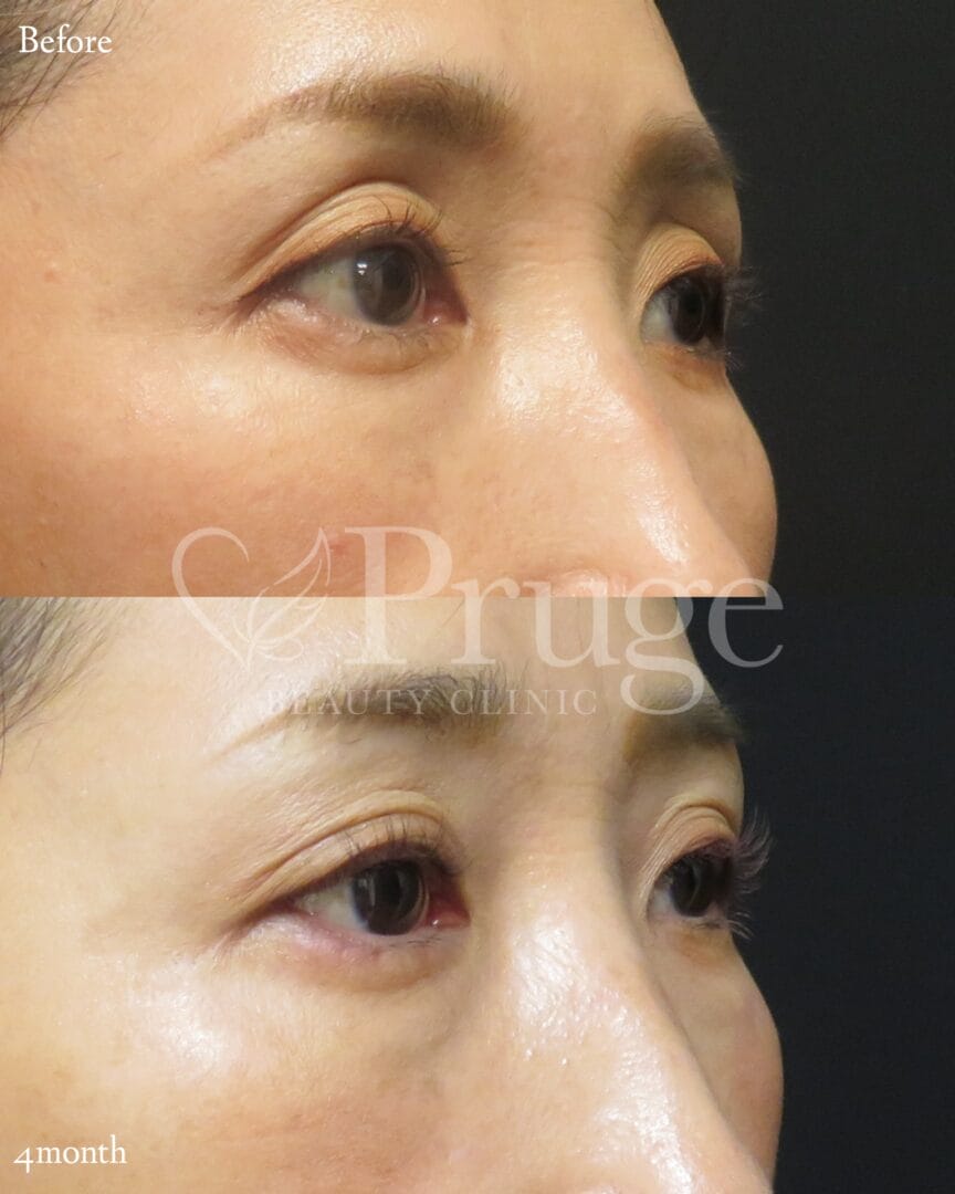 PRP注射(目の上)