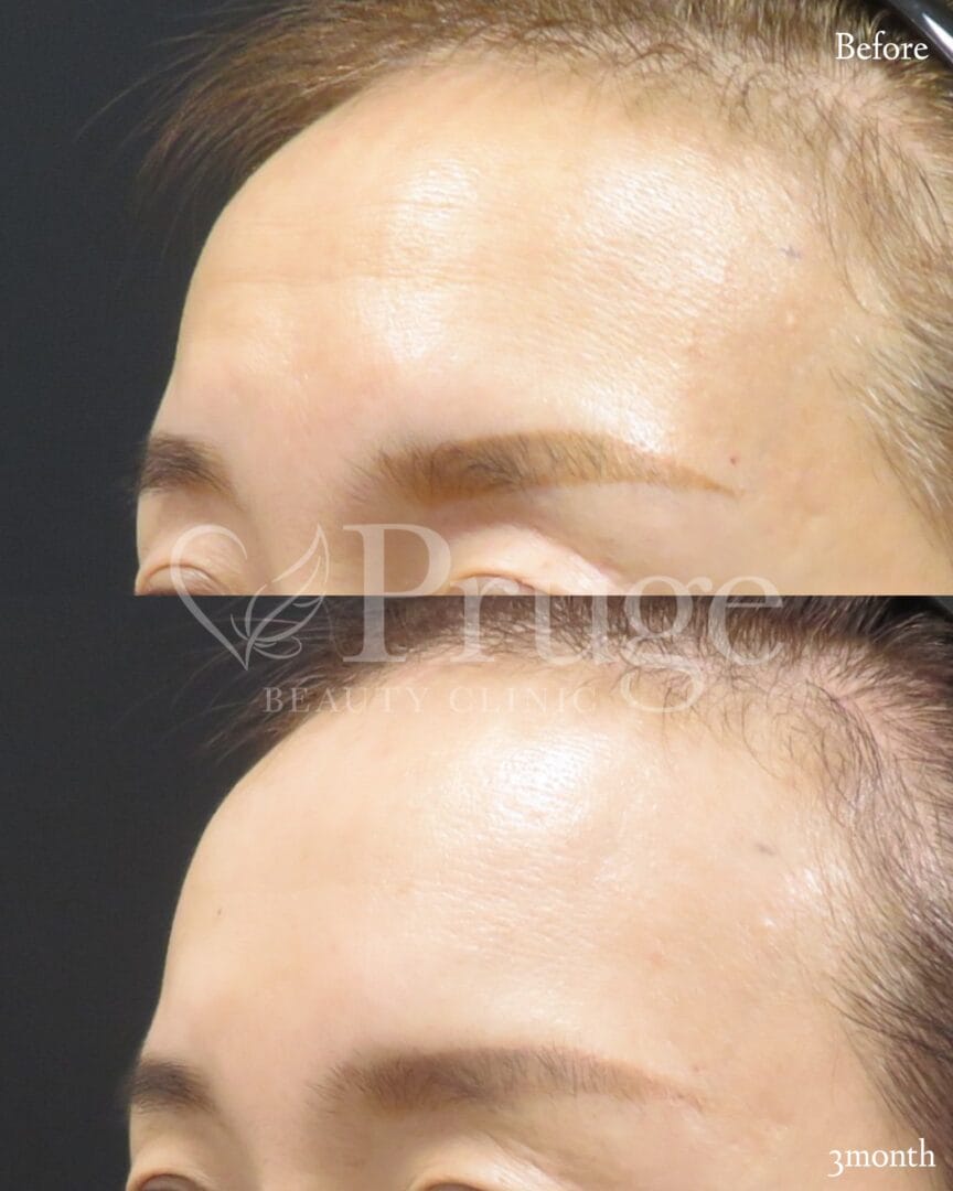 PRP注射(額のシワ)