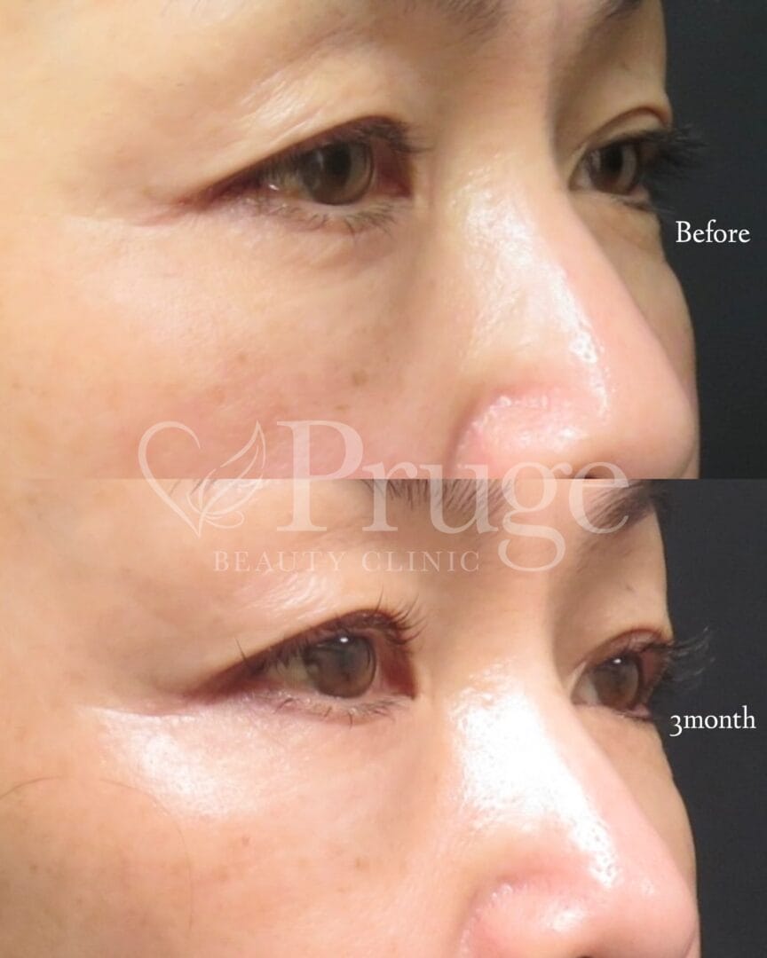 PRP注射(目の下)