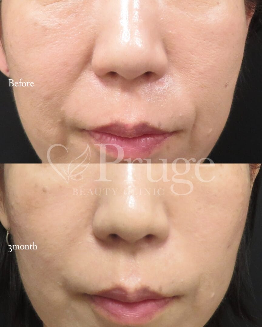 PRP注射(法令線)