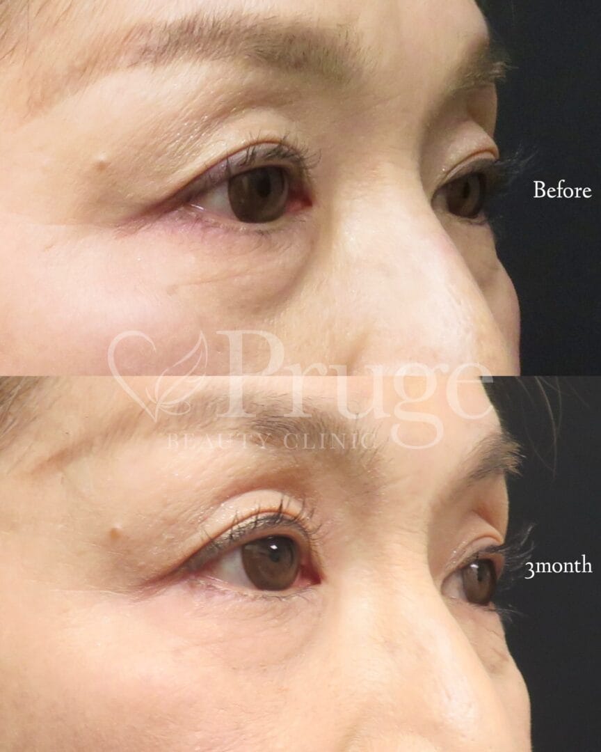 PRP注射（目の下）