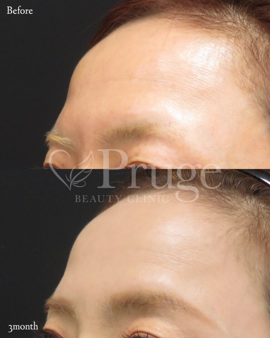 PRP注射(額のシワ)