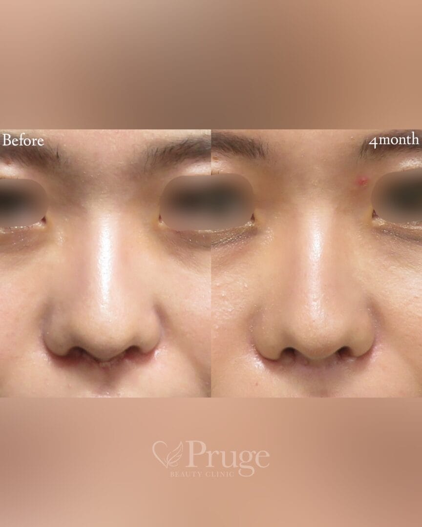 PRP注射(鼻尖・鼻根)