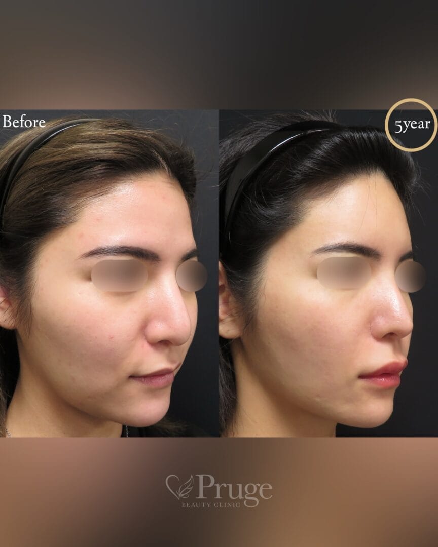 PRP注射(ひたい・こめかみ丸み形成)