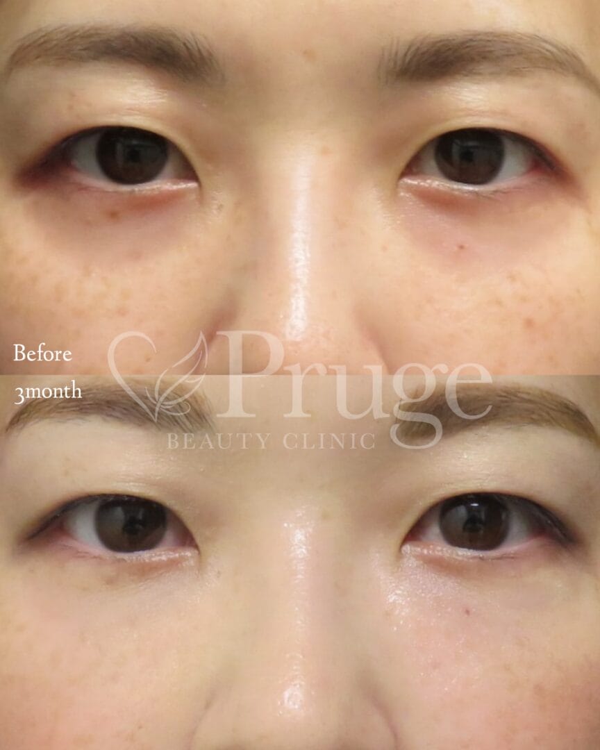 PRP注射(目の下)