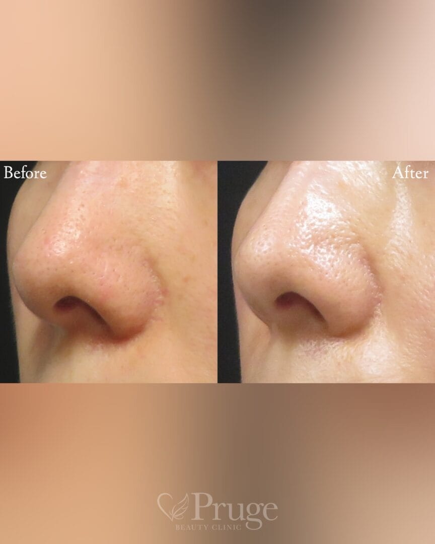 鼻横の血管に対するフェイススクレロセラピー