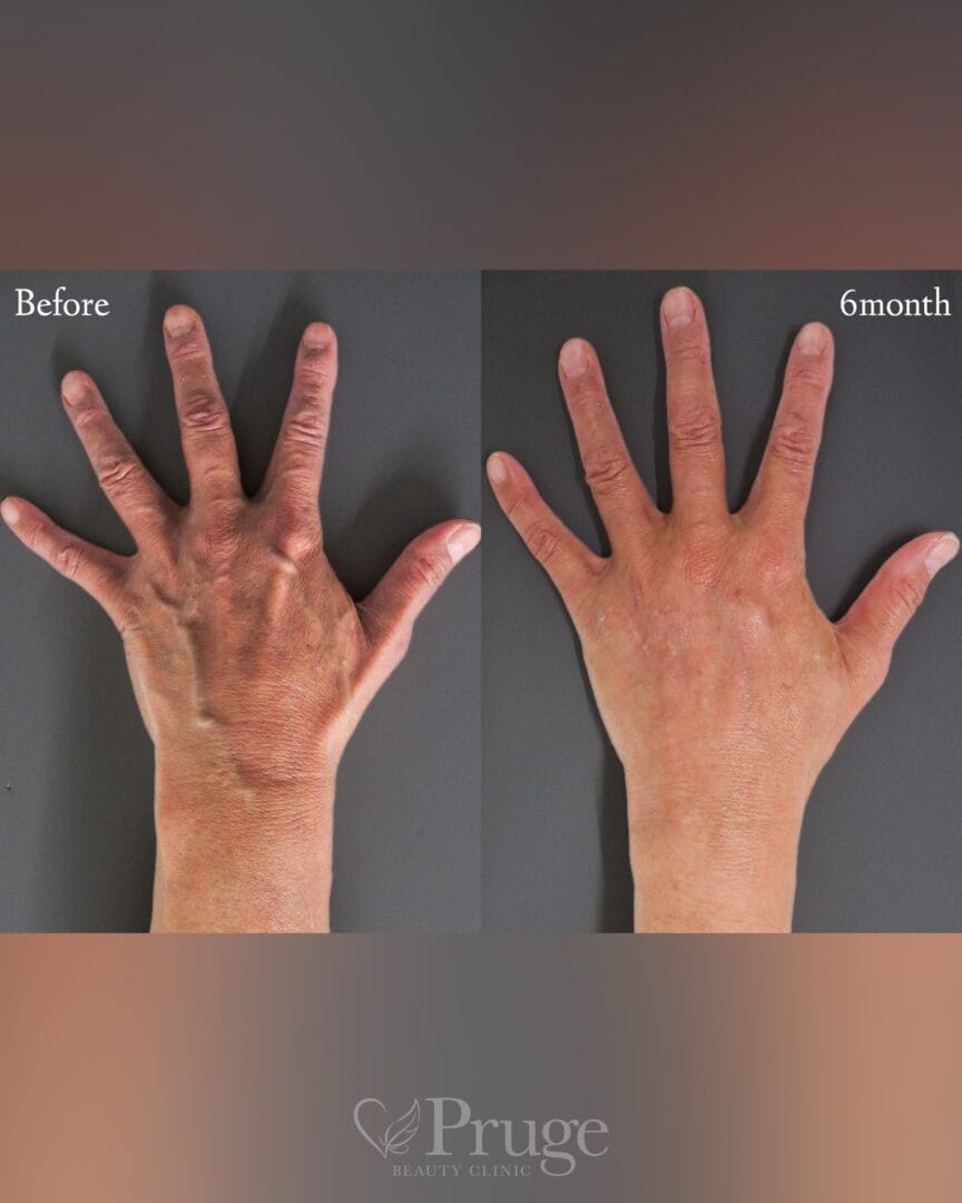 PRP注射・ハンドレーザー(手の甲)