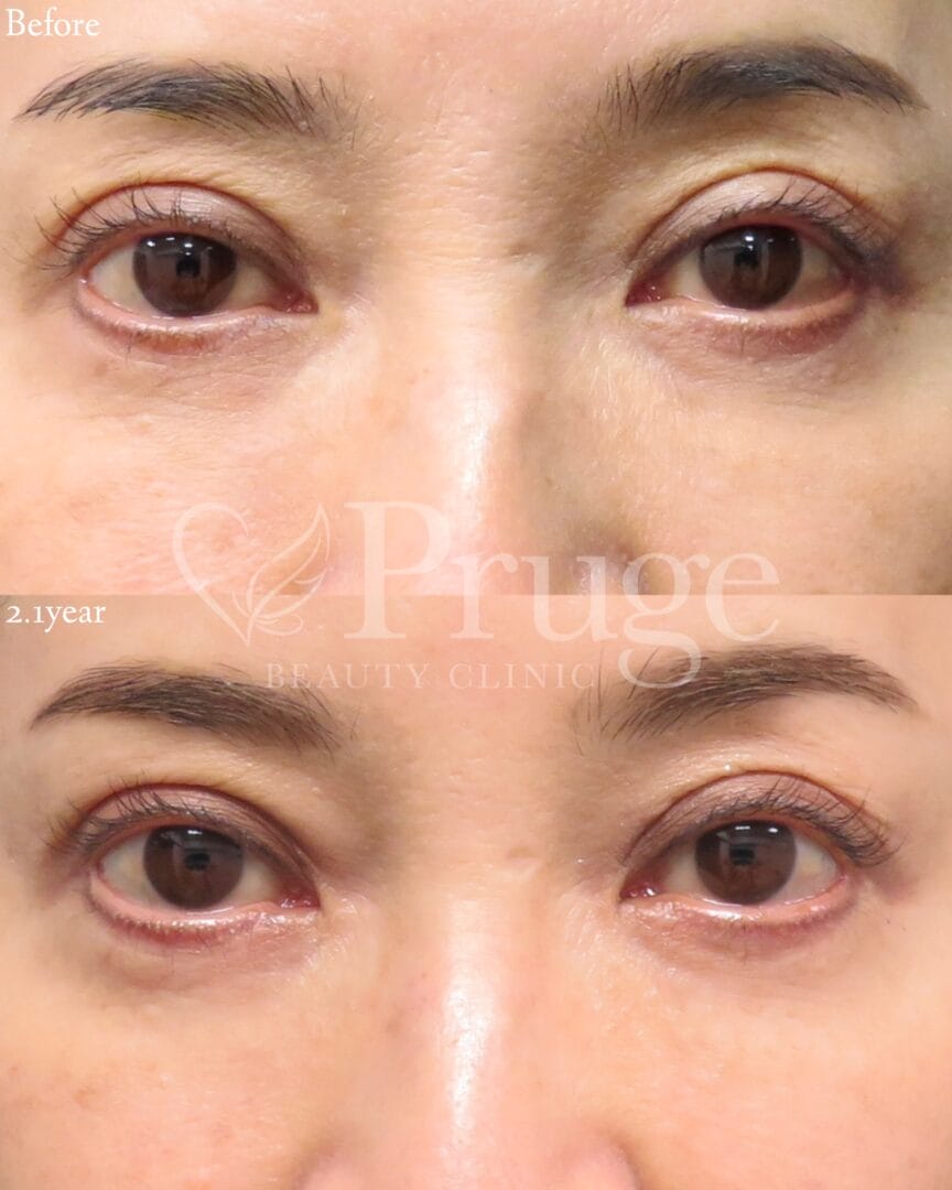 PRP注射(目の下・目頭)