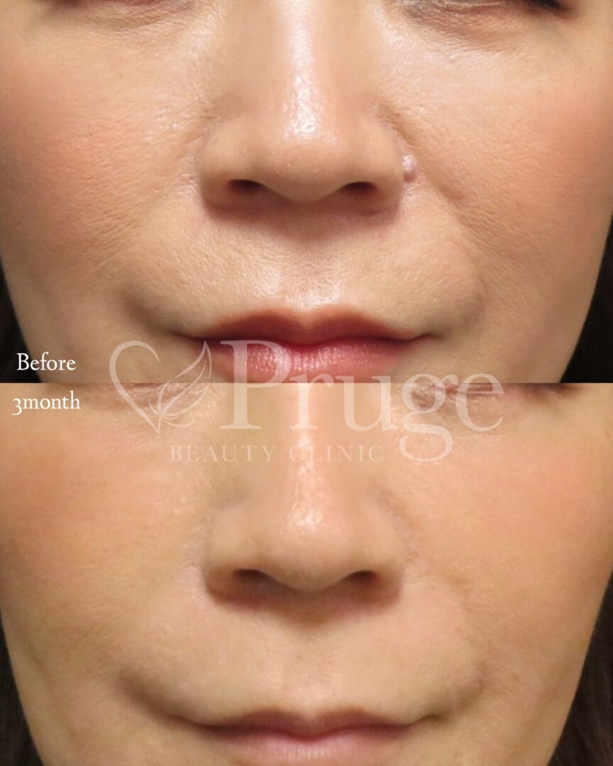 PRP注射(法令線)