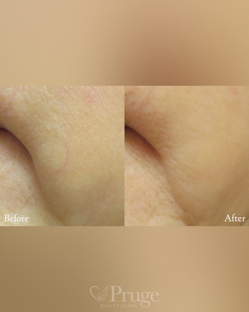 口横の血管に対するフェイススクレロセラピー