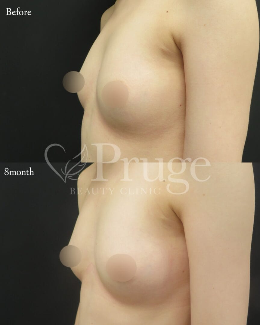 PRP注射によるバストアップ