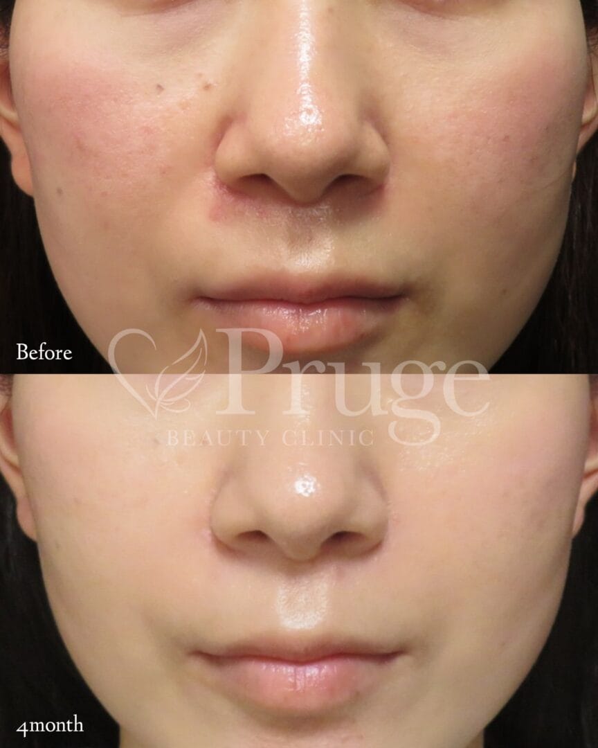 PRP注射(鼻翼基部)