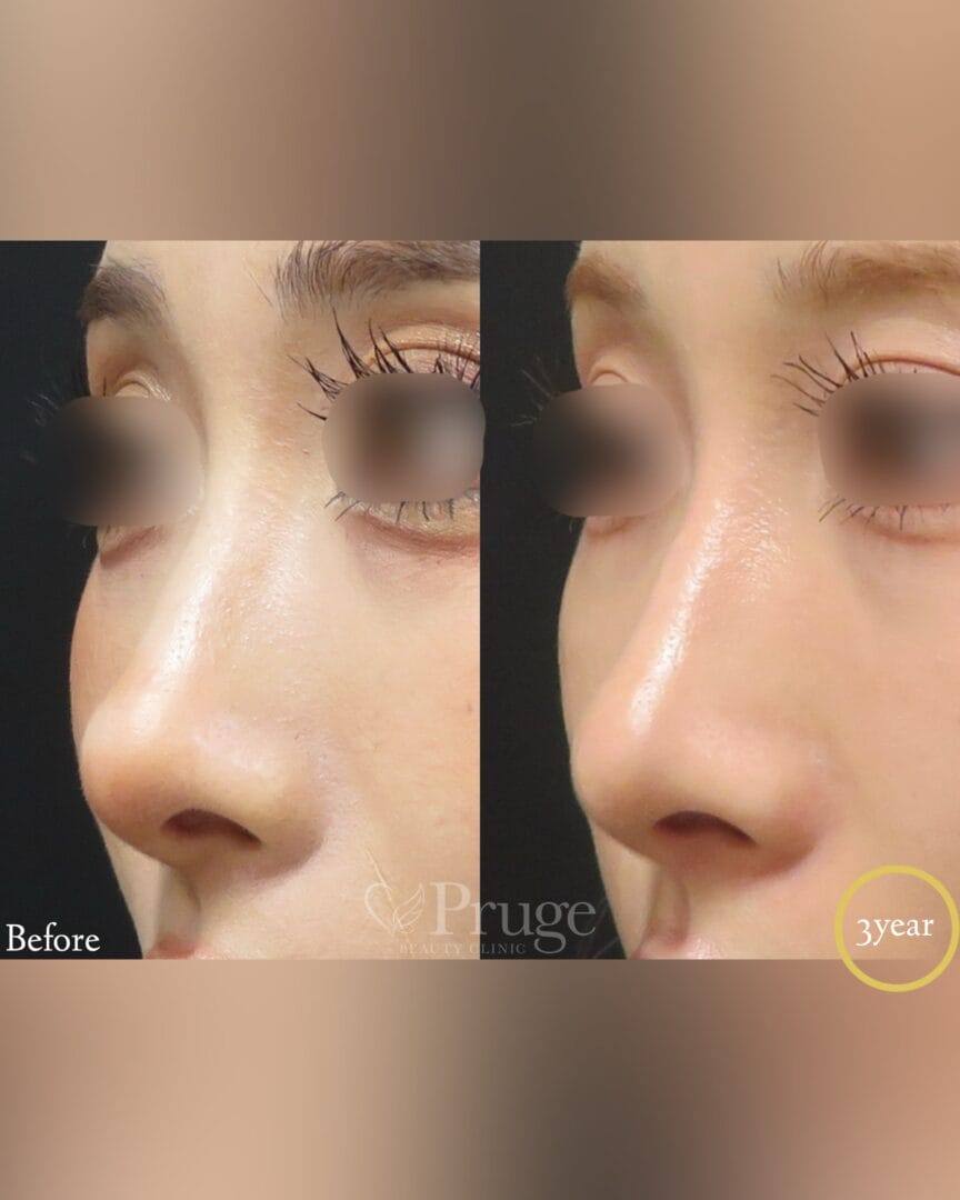 PRP注射(鼻根・鼻孔・鼻尖)