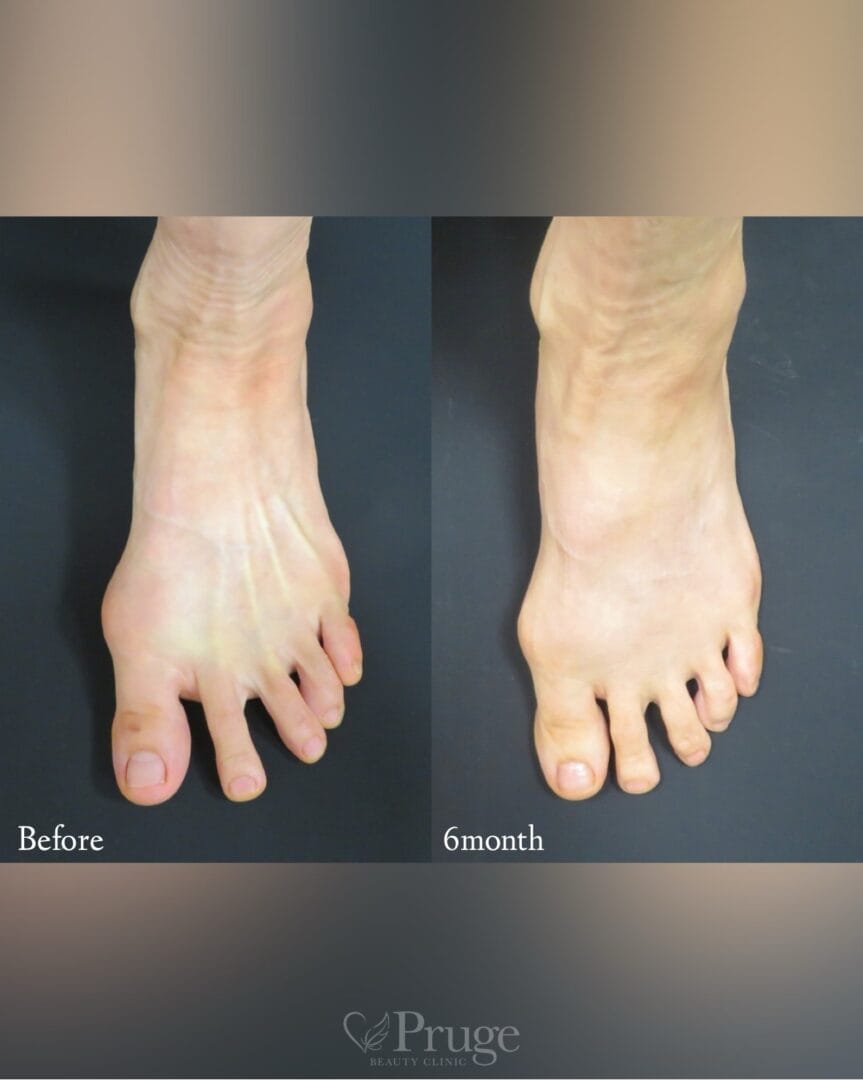 PRP注射（足の甲）