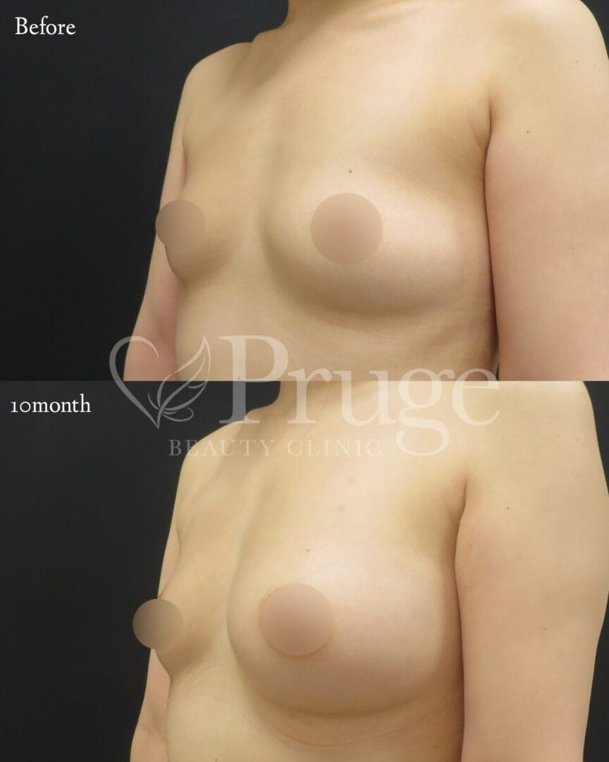 PRP注射によるバストアップ