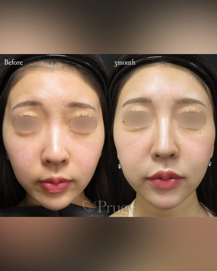 PRP注射(ひたい・こめかみ丸み形成)