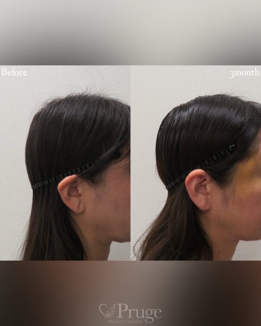 PRP注射(後頭部形成術)