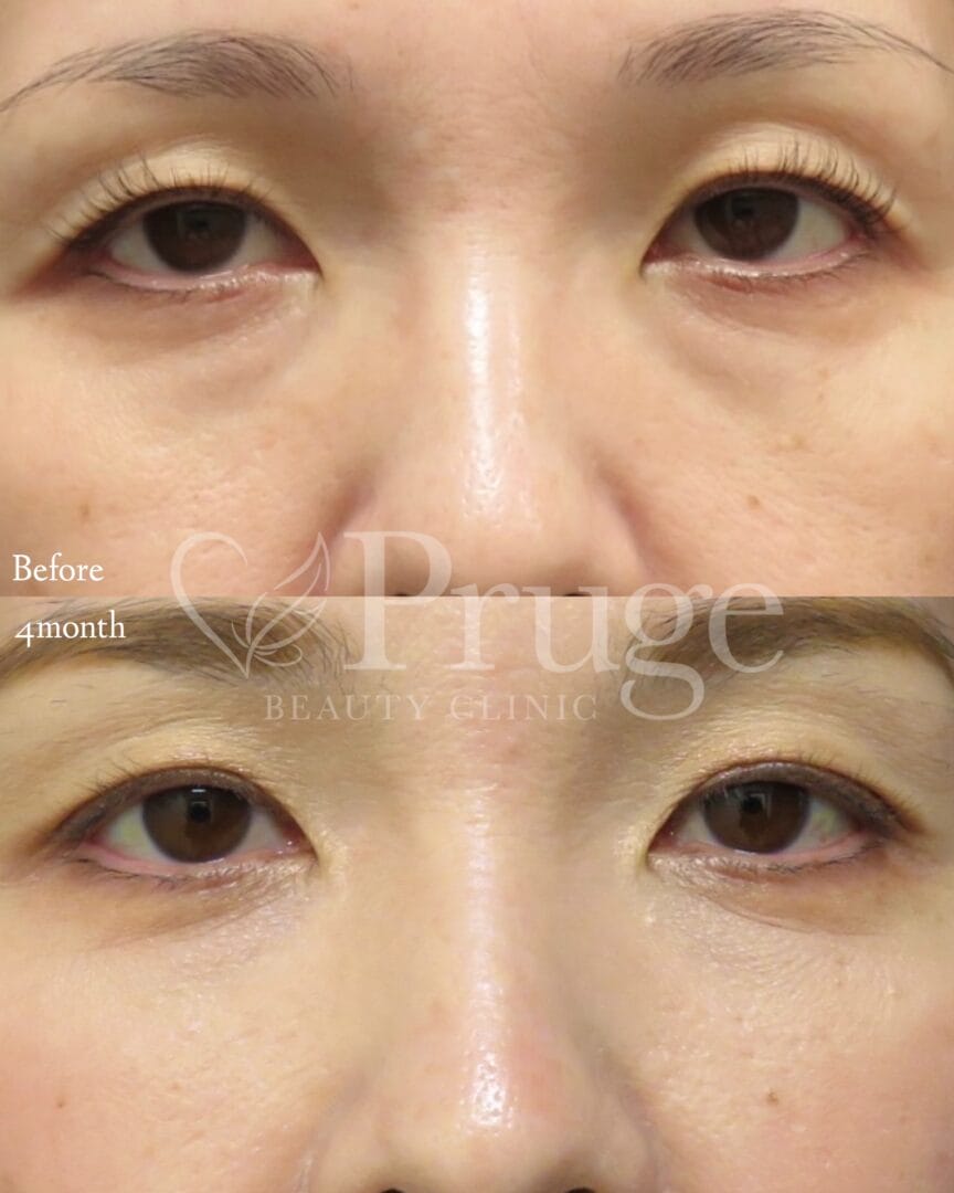 PRP注射(目の下)