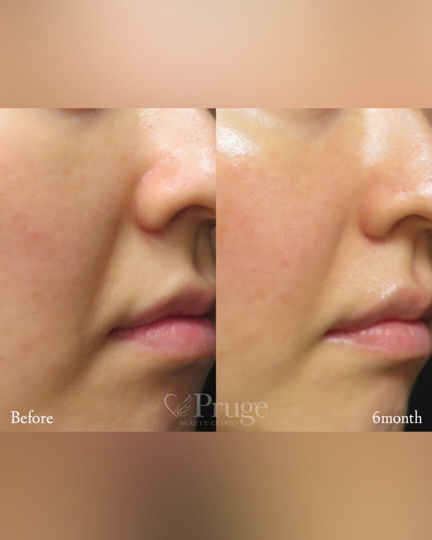 PRP注射(ほうれい線)