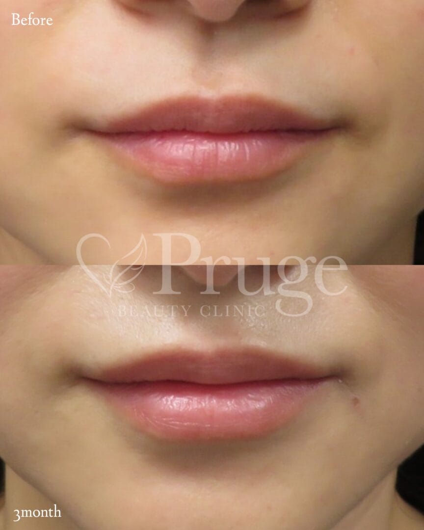 PRP注射（唇）