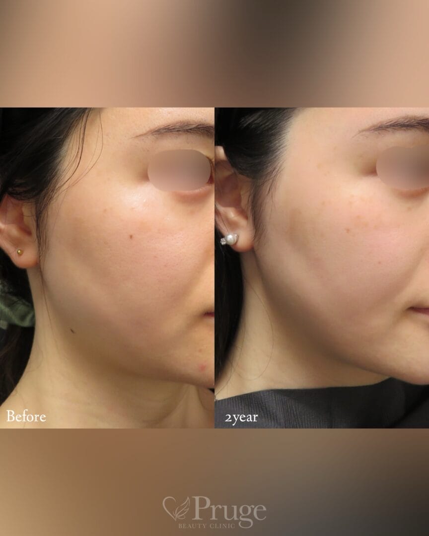 pスリム注射(フェイスライン)