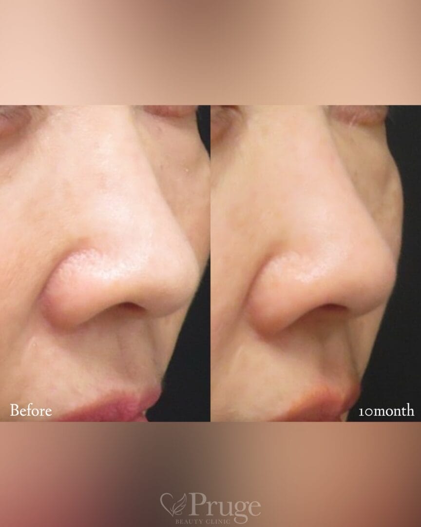 PRP注射(鼻孔縁)