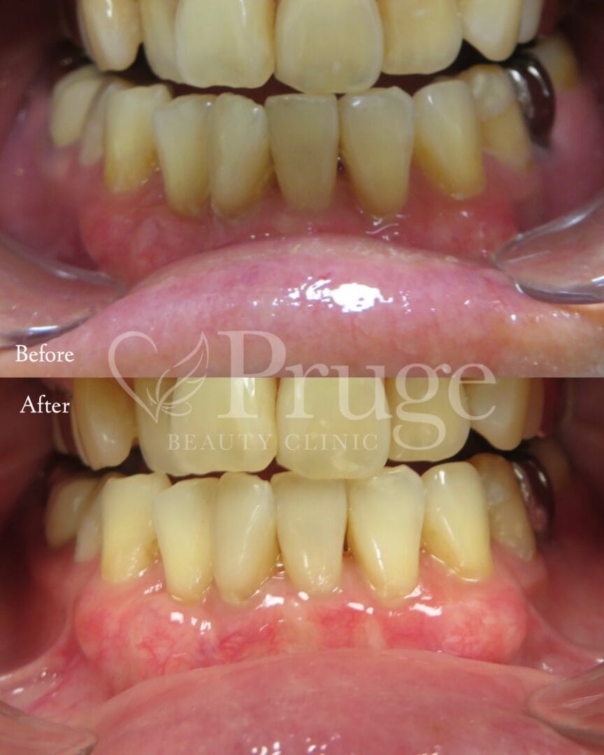 PRP注射による歯肉再生