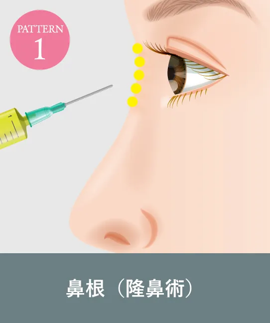 鼻根形成術(隆鼻術)