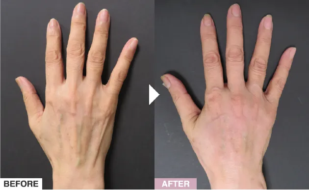 ハンドスクレロセラピーの症例写真