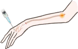 「ハンドスクレロセラピー」＋「レーザー治療」のコンビネーション