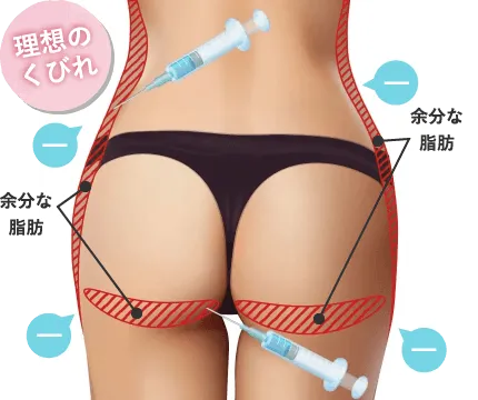 pスリム注射/脂肪を溶解