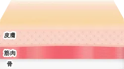 ボトックスによる治療