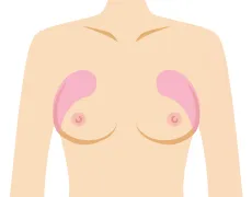 上胸ワキ側のそげを改善したい