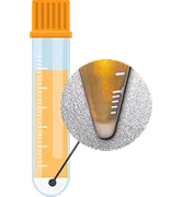 成長因子を含んだ血小板（当院作製）