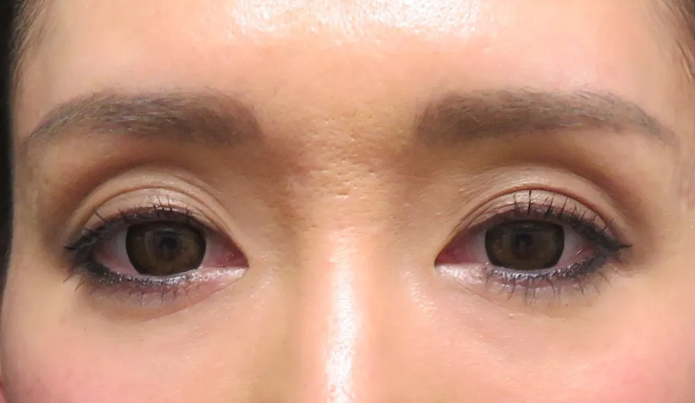 まぶたがくぼみ、影ができ、深いシワ（線）もできている状態