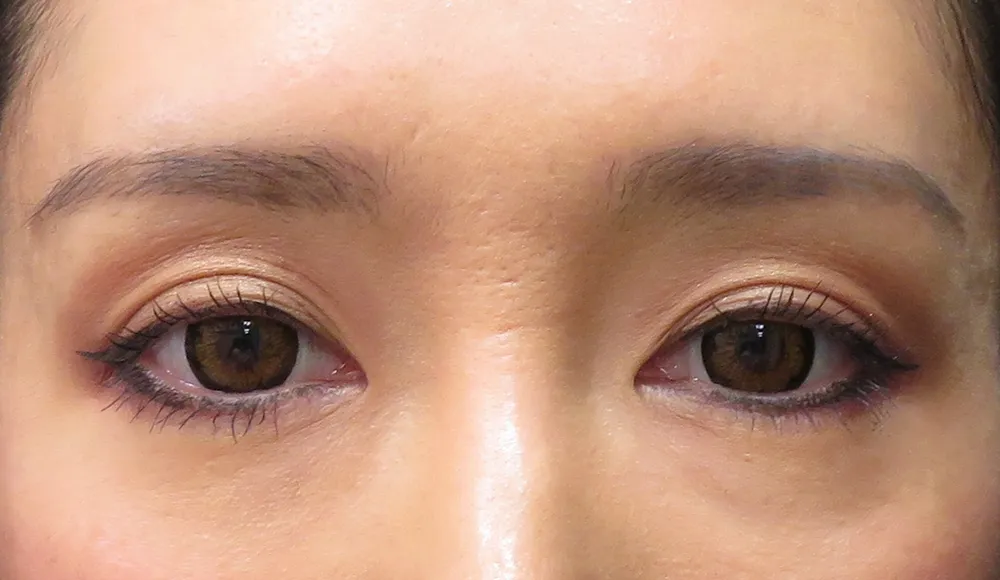 肌細胞の再生により皮膚がふっくら改善。くすみも解消