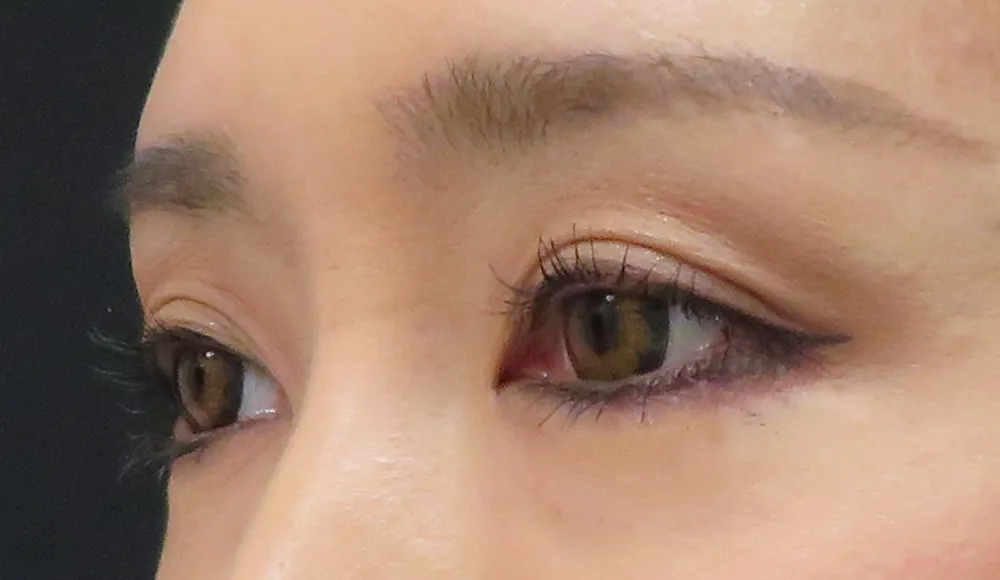 肌細胞の再生により皮膚がふっくら改善。皮膚のよれも解消