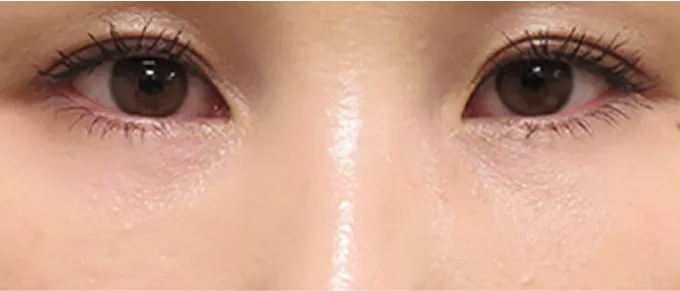 肌細胞の産生作用により、皮膚の厚みが正常化し、青みが改善する。