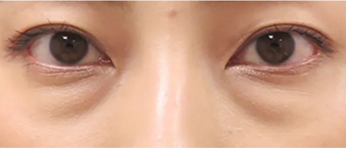 目の下の膨らみやたるみ、むくみにより影ができた状態。