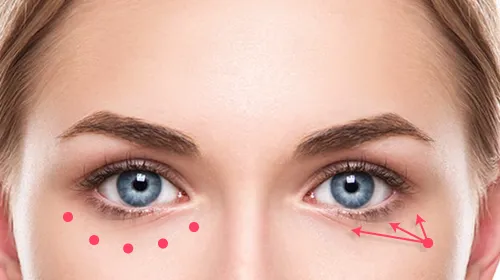 マジック・ニードルは、針先が丸くて細いから痛くない。