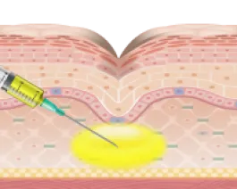 凹みやくすみの部分にPRPを注入