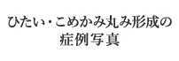 おでこPRP注射の症例