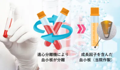 独自のPRP作製技術