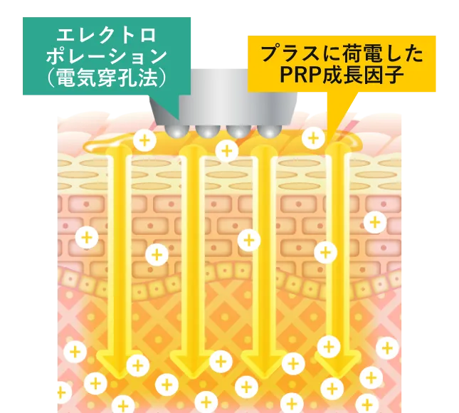 エレクトロポレーションで、一時的にできた角質孔からPRP注射液を電気的に真皮深層までデリバリー