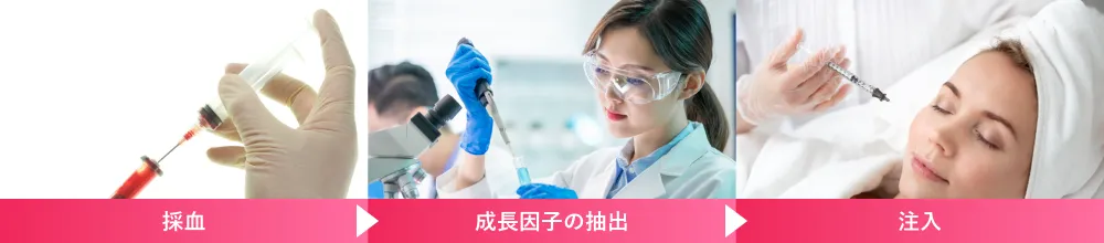 採血➡成長因子の抽出➡注入