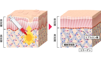 持続効果は5年以上！