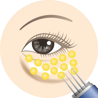 マイクロインジェクション