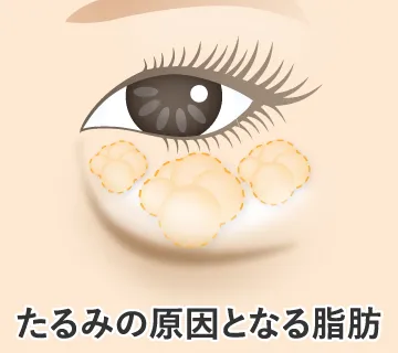 たるみの原因となる脂肪のイラスト