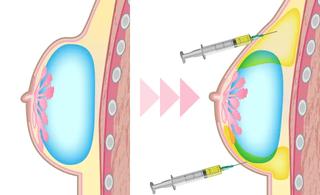 before:乳房の立ち上がりが急で不自然 after:バストが自然に見えるように、PRP注射で肌再生を促す