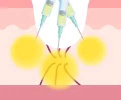 クレーター部分にPRP成分を注入